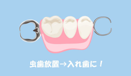 体験談！虫歯を１年以上放置し30代で入れ歯に…歯科へ行けず悩むあなたへ届け！
